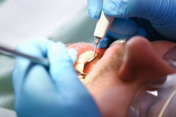 Best Emergency Dentist for Lost Fillings or Crowns in Swede Heaven, WA