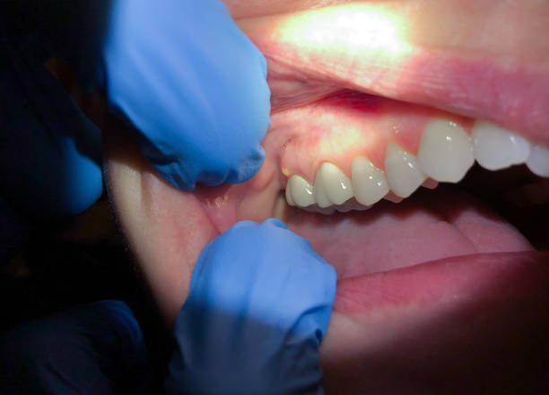 Best Emergency Dentist for Knocked-Out Tooth in Swede Heaven, WA
